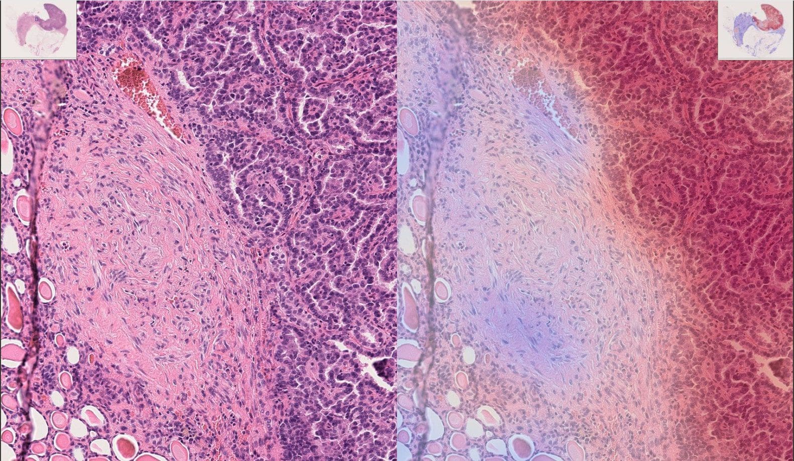 Explainable AI kidney WSI